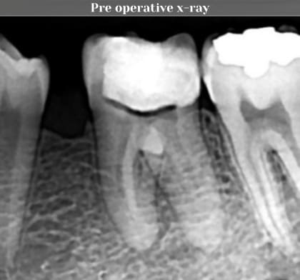 Pre operative x-ray