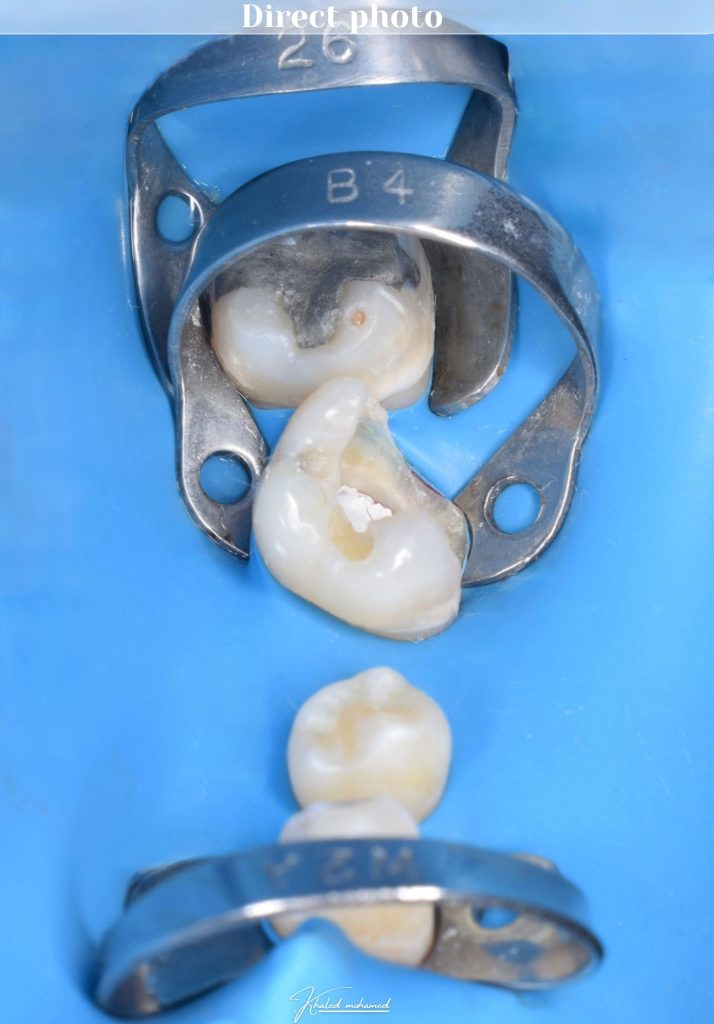 Direct view for isolation