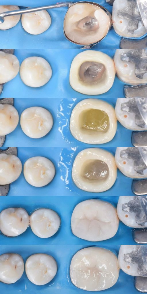 Direct overlay workflow