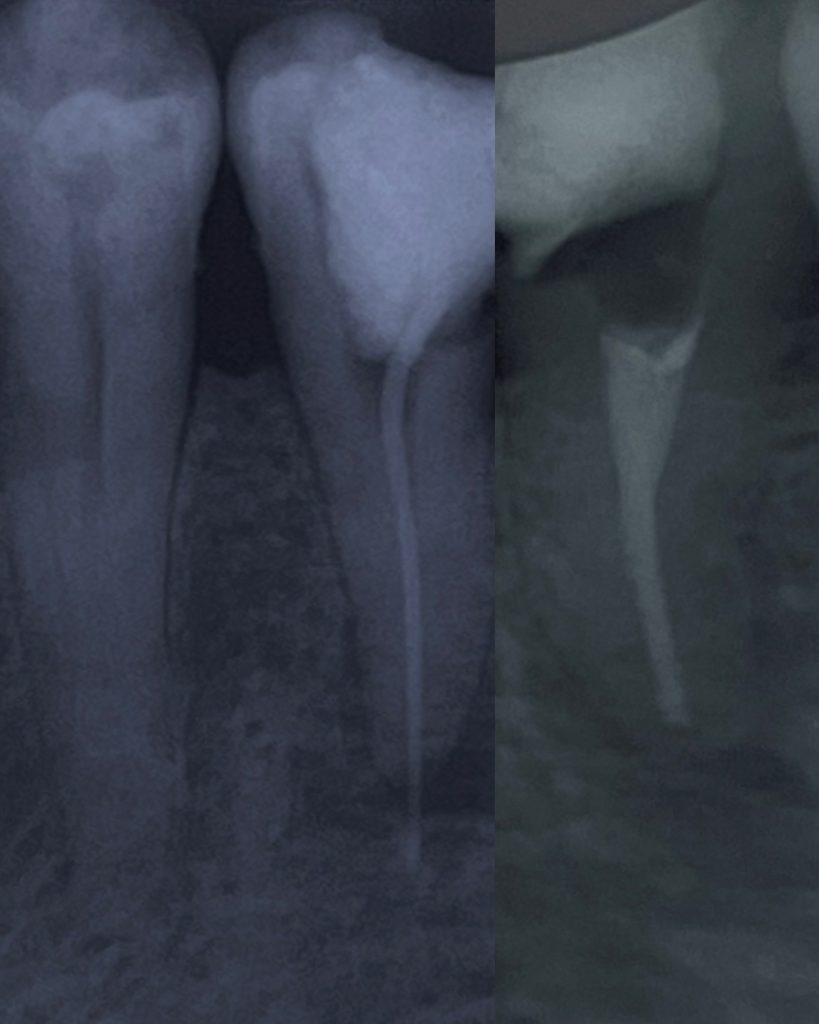 External root resorption RCT (0 grade mobility), DME & fiber reinforced ...