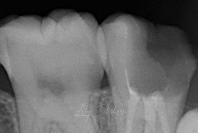 EBRAHIM_YOUSRA_Light box(1)_Intraoral_20250416_201959
