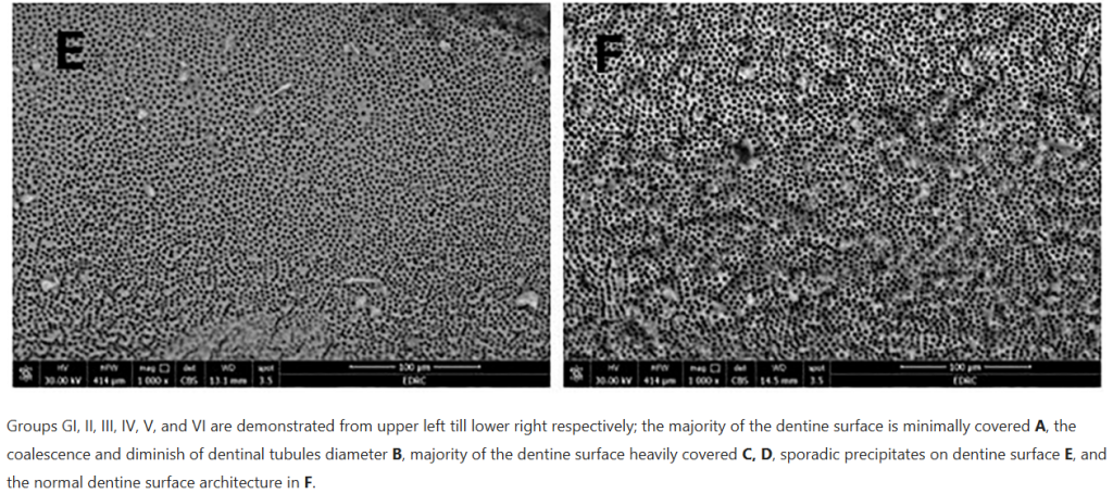 Laser-Assisted nano-MTA Precipitation on Root Canal Dentin