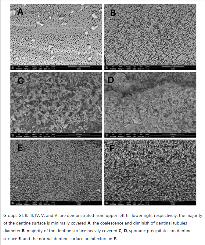 Laser-Assisted nano-MTA Precipitation on Root Canal Dentin