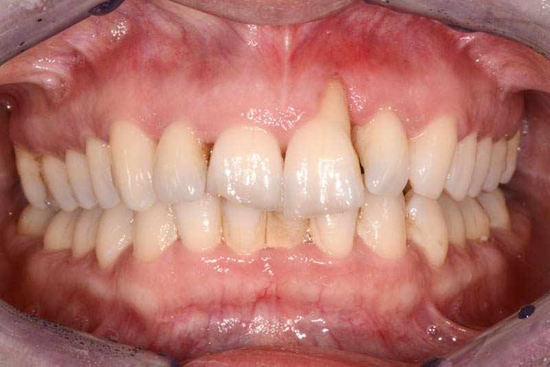 INITIAL SITUATION - INTRAORAL VIEW