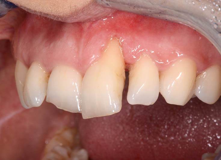 INITIAL SITUATION - LATERAL VIEW