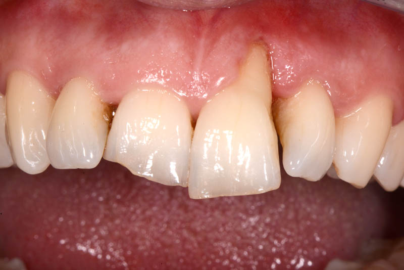 INITIAL SITUATION - INTRAORAL FRONTAL VIEW