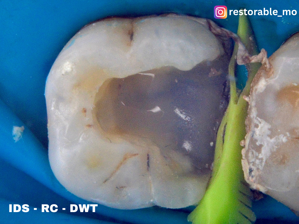 Challenging access cavity