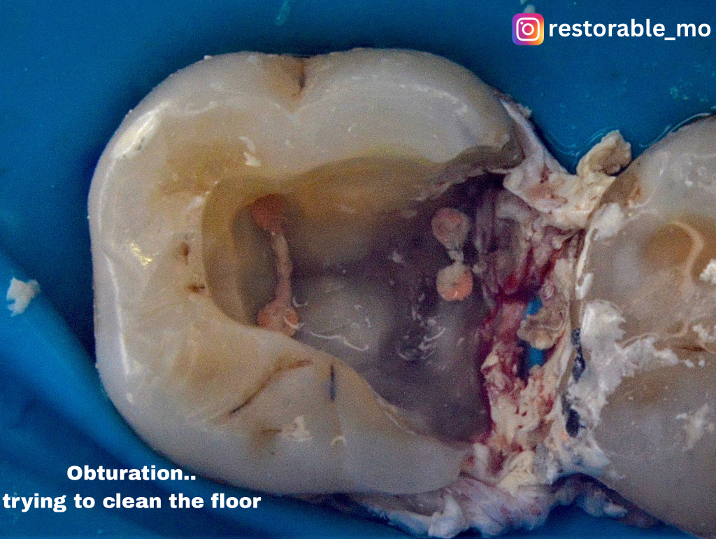 Challenging access cavity