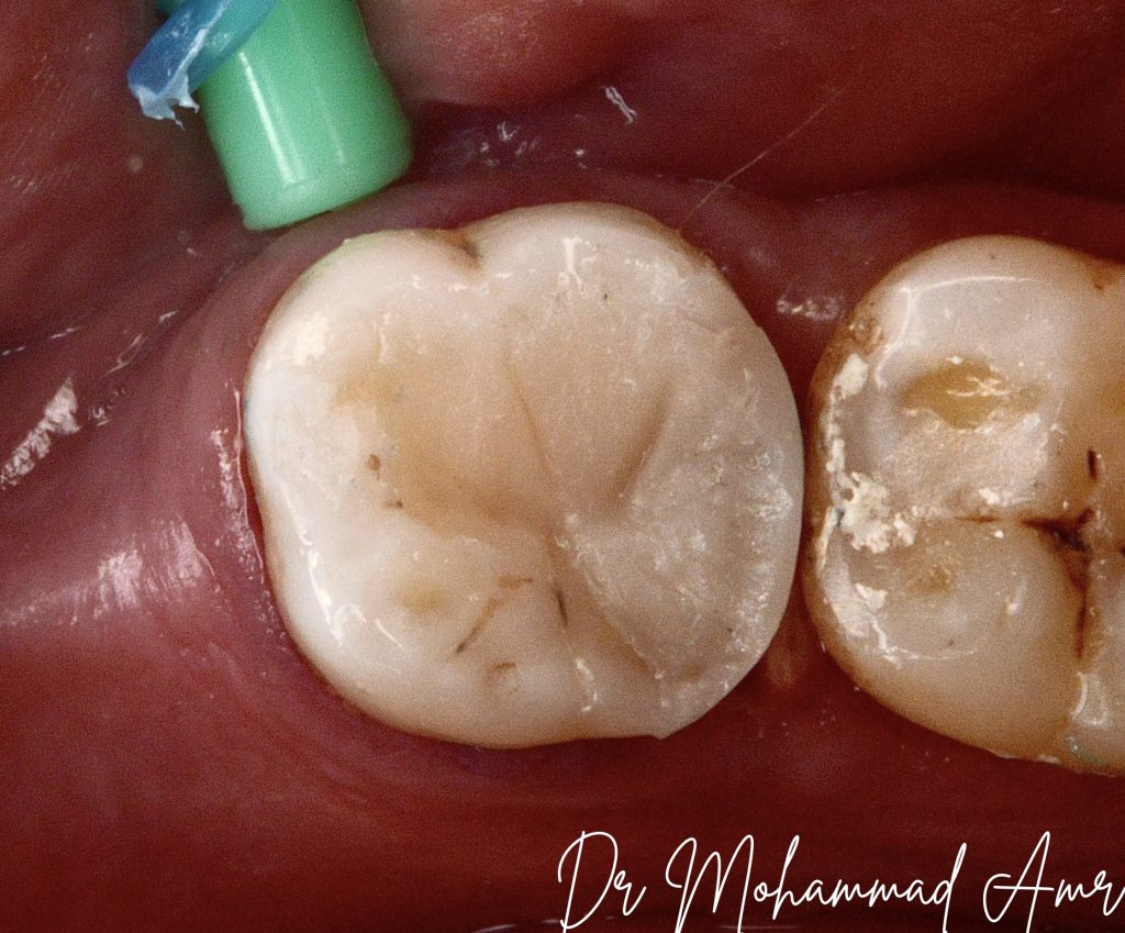 Challenging access cavity