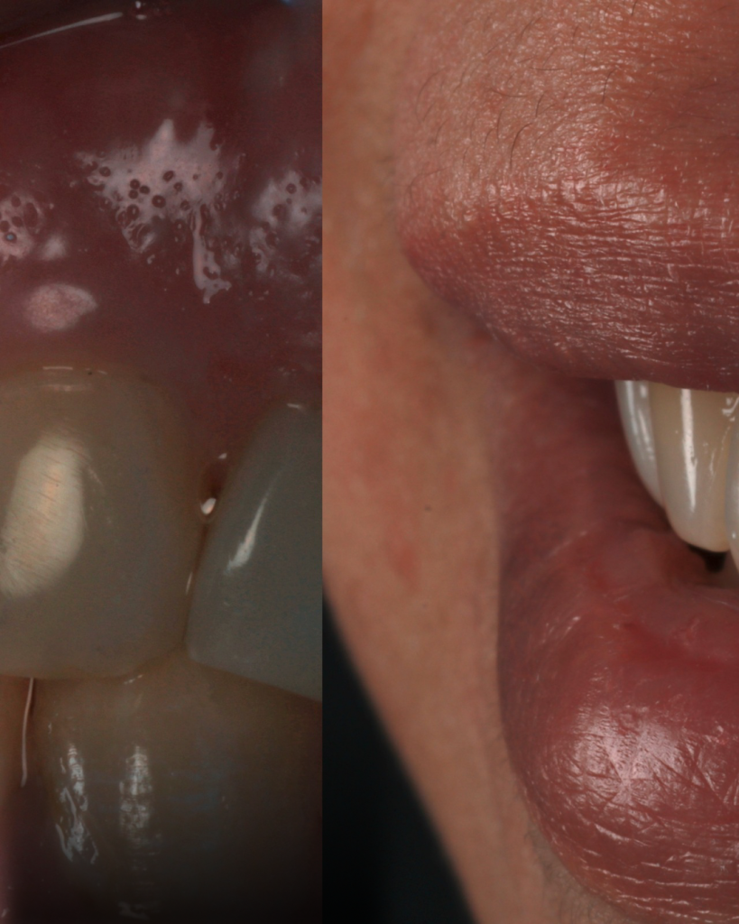 Diastema - 8