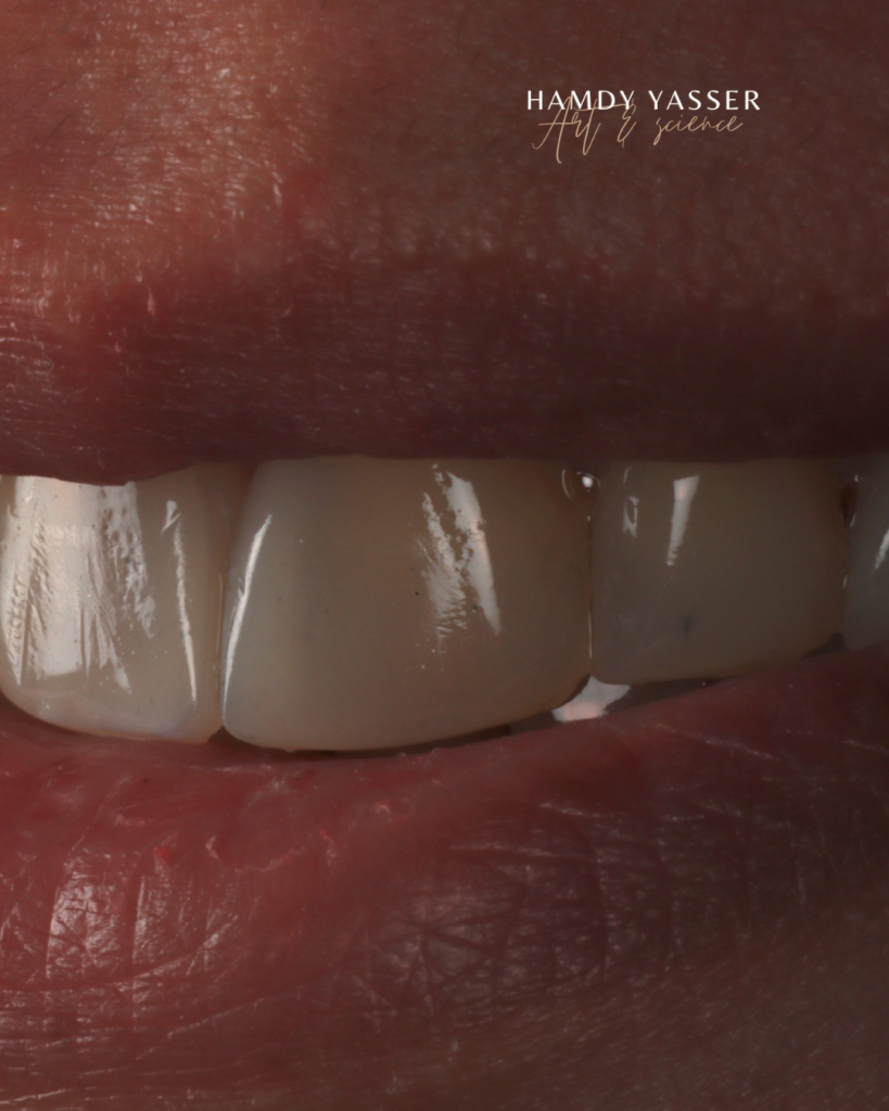 Diastema - 9