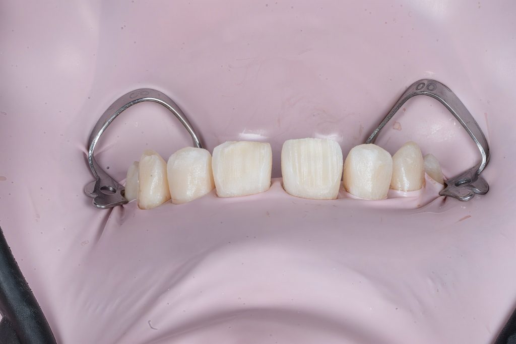 Microscope-Assisted Direct Composite Veneers with Digital Smile