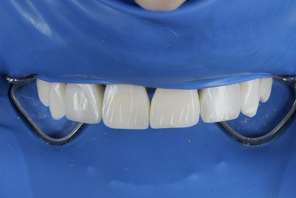Microscope-Assisted Direct Composite Veneers with Digital Smile