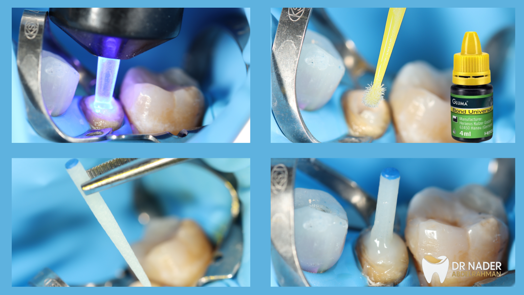 Post Cementation
