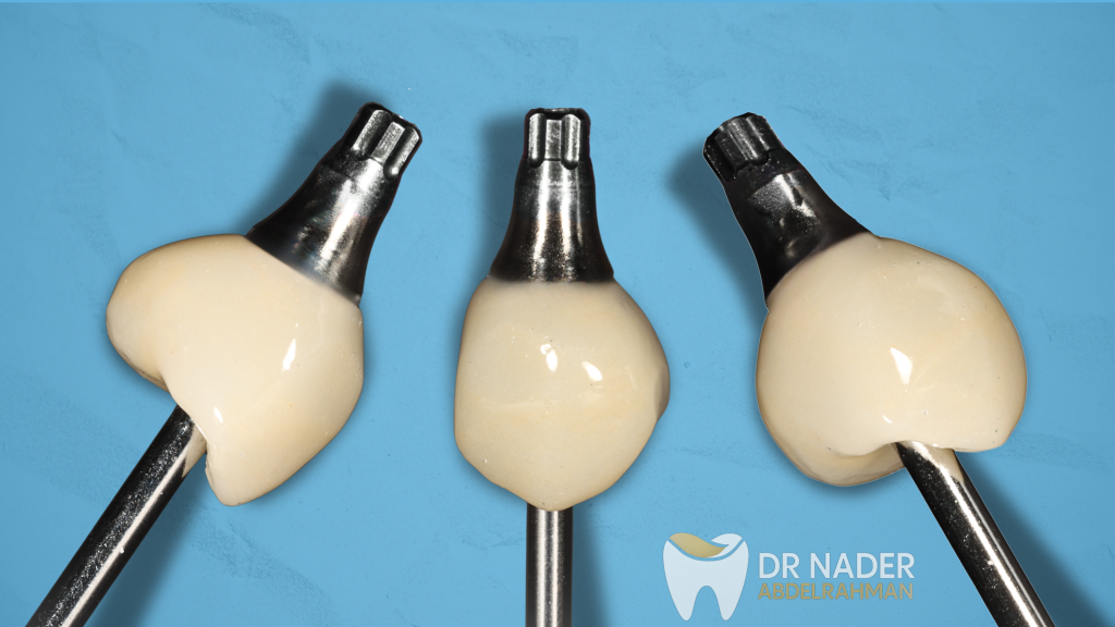 Final Implant Prosthesis