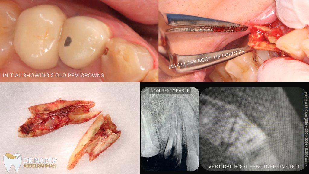 Initial Situation and Extraction