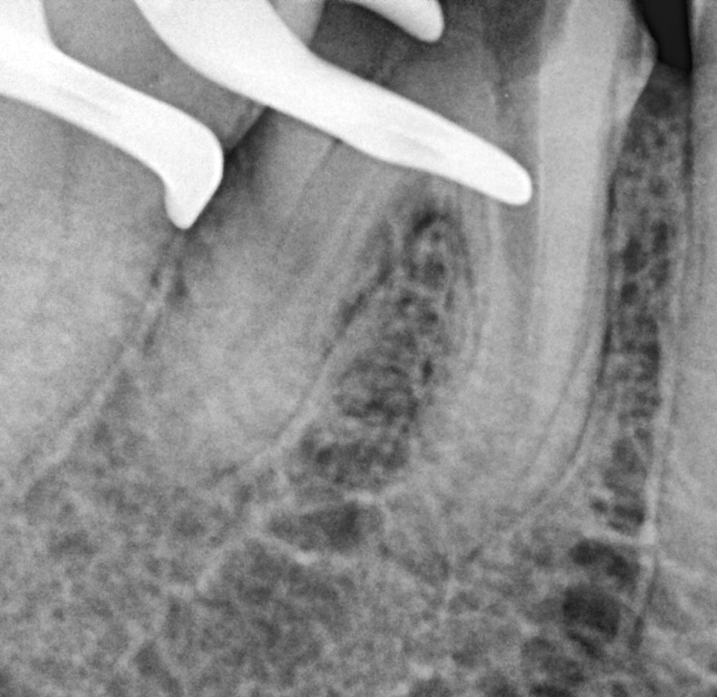 2x gutta percha removal