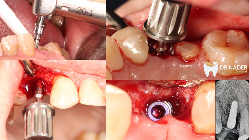 Drilling and Axis Determination