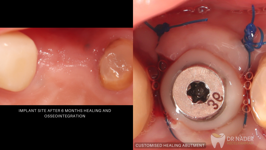 Healed Implant Site