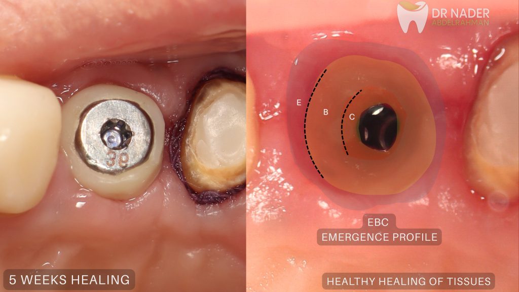Final Healing of Tissues and EBC Concept