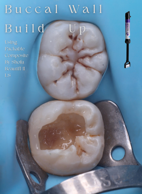 Buccal Wall Build - Up