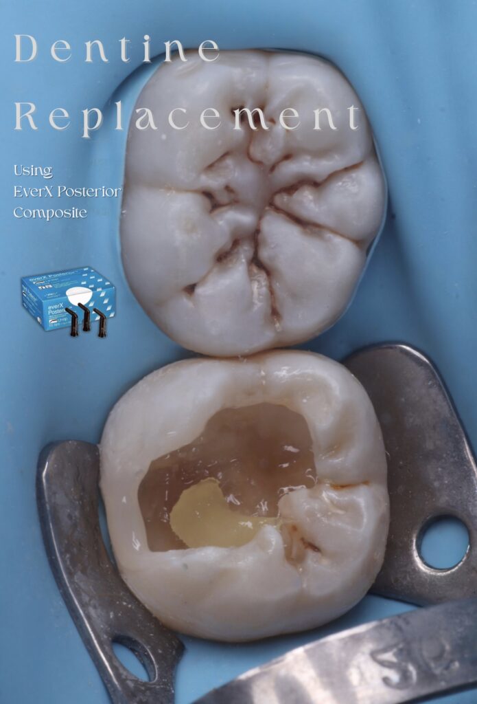 Dentine Replacement