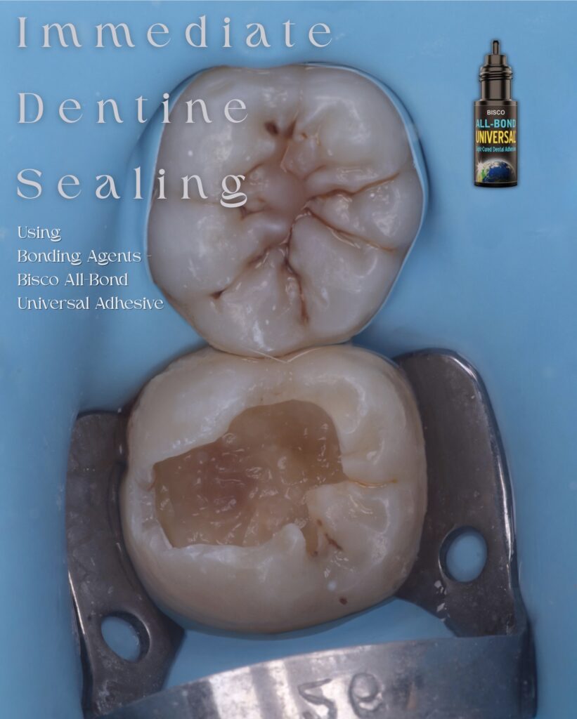 Dentine immediate sealing - 1