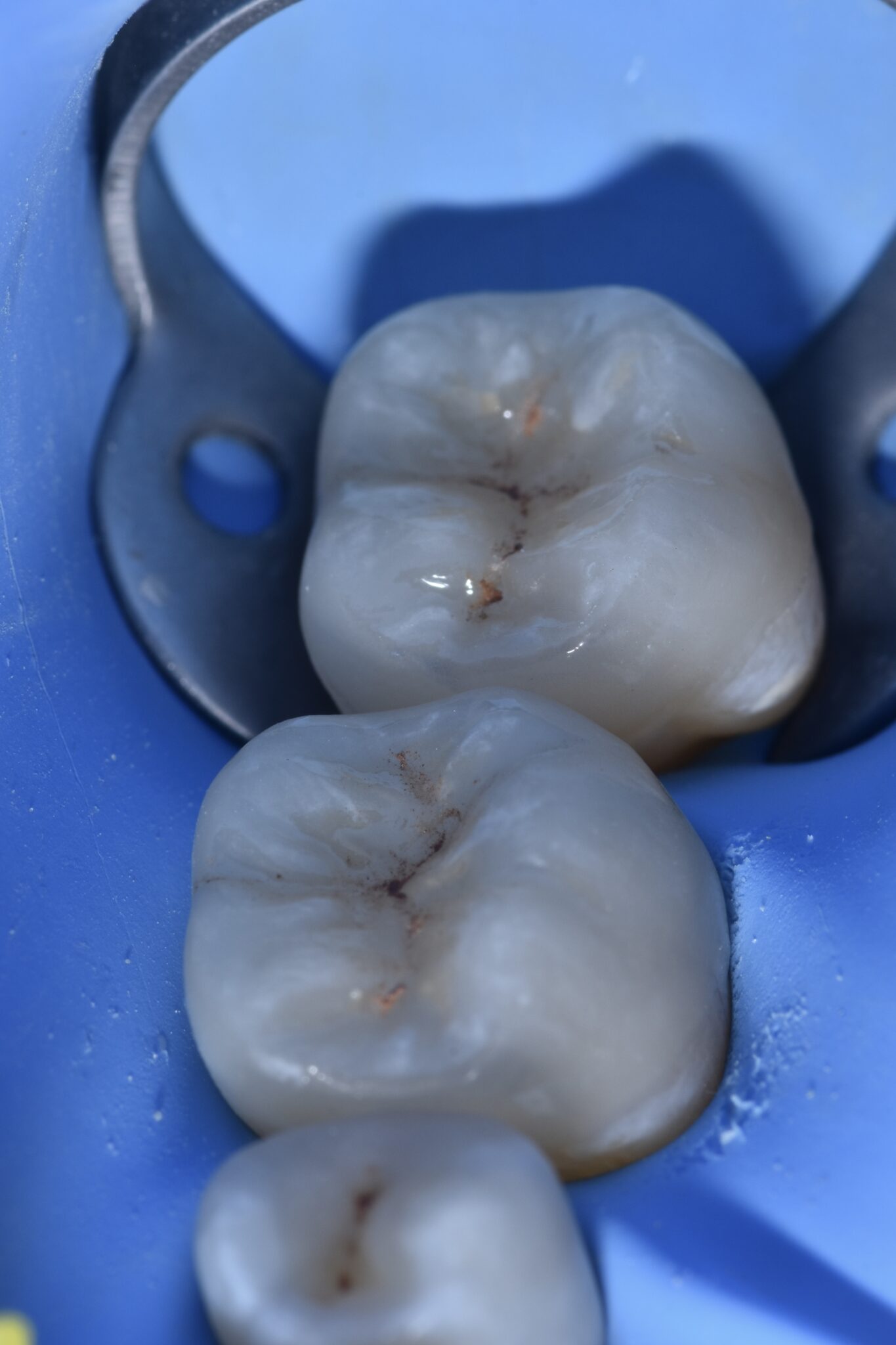 Compromised Tooth Indirect adhesive restoration on a severely compromised tooth - MyZerodonto