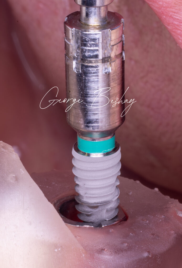 implant insertion