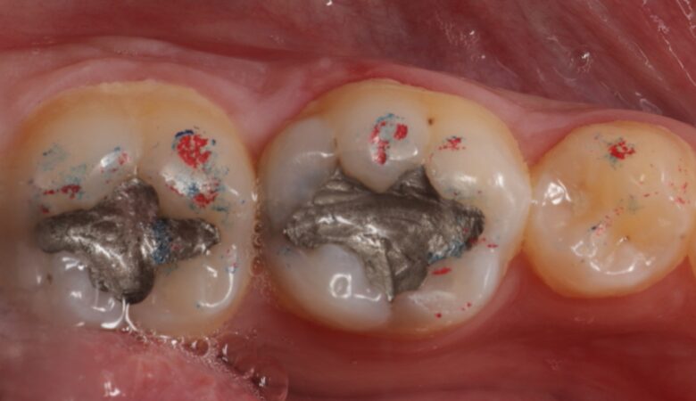 Pre-operative with occlusal record 