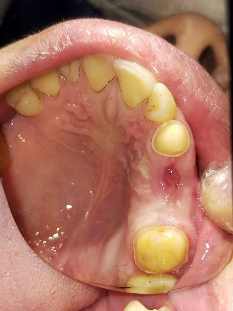 Prepared teeth