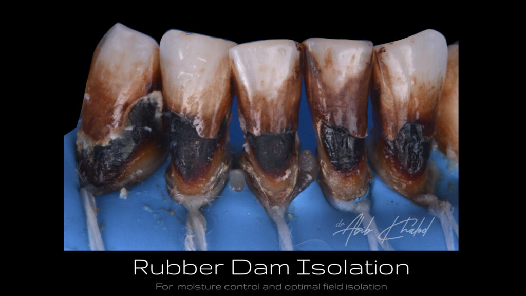Rubber Dam Isolation