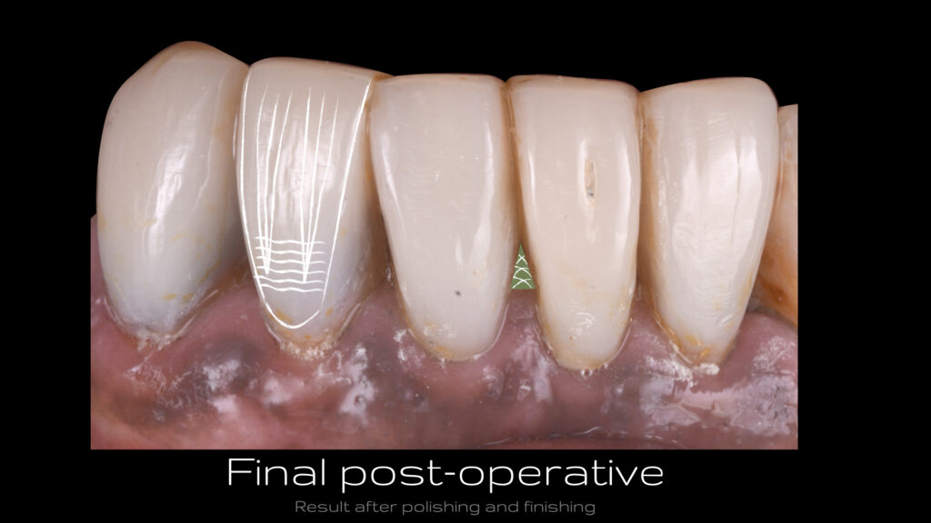 Final post-operative