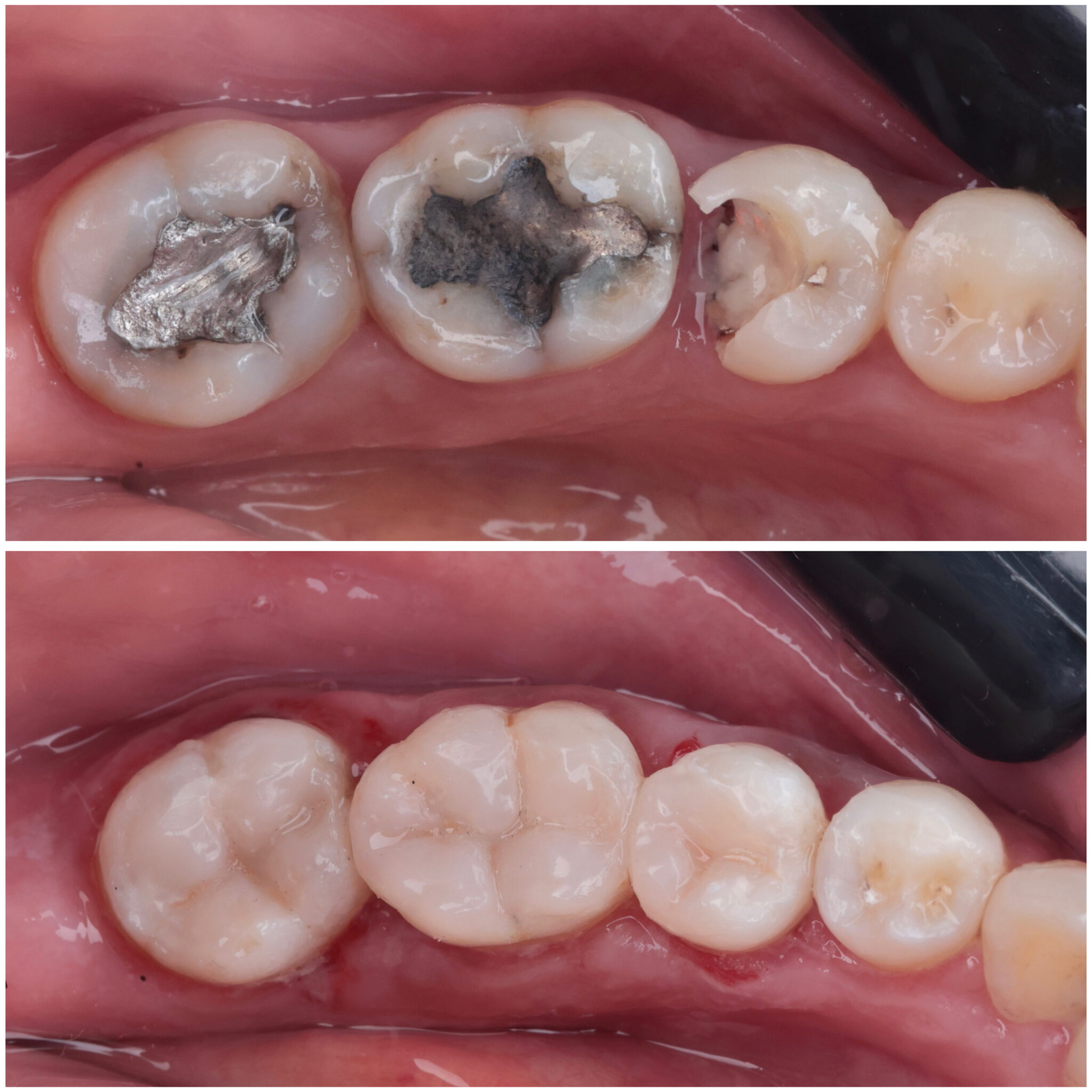 From Compromised to Confident: A Full-Quadrant Rehabilitation
