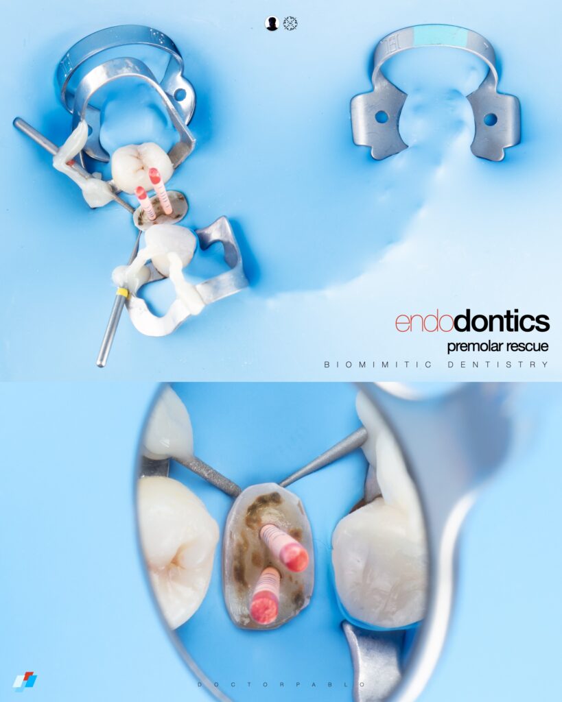 Endodontics Tx
