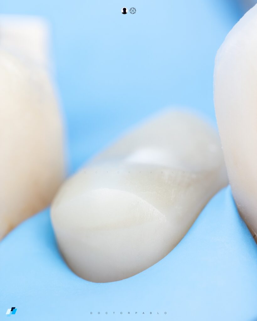 Indirect Restoration