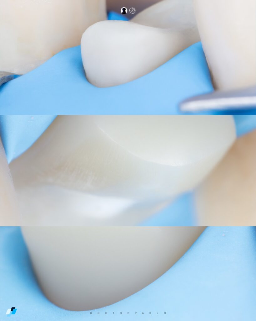 Indirect Restoration Preparation