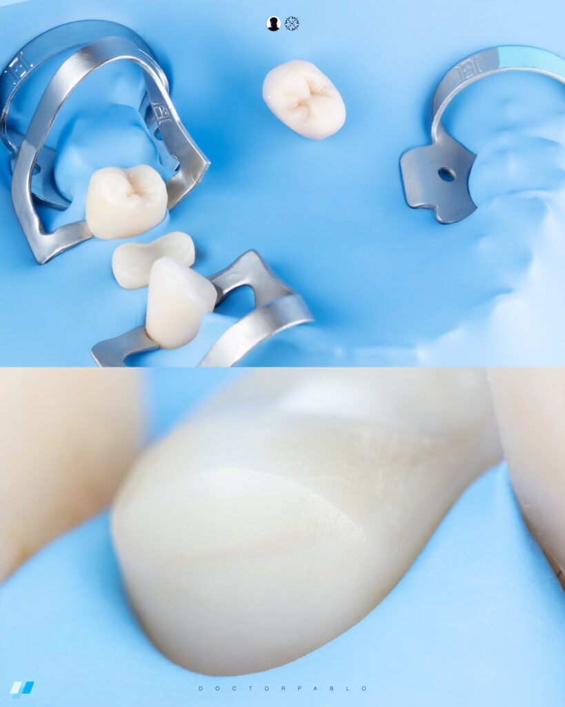 Indirect Restoration Cementation