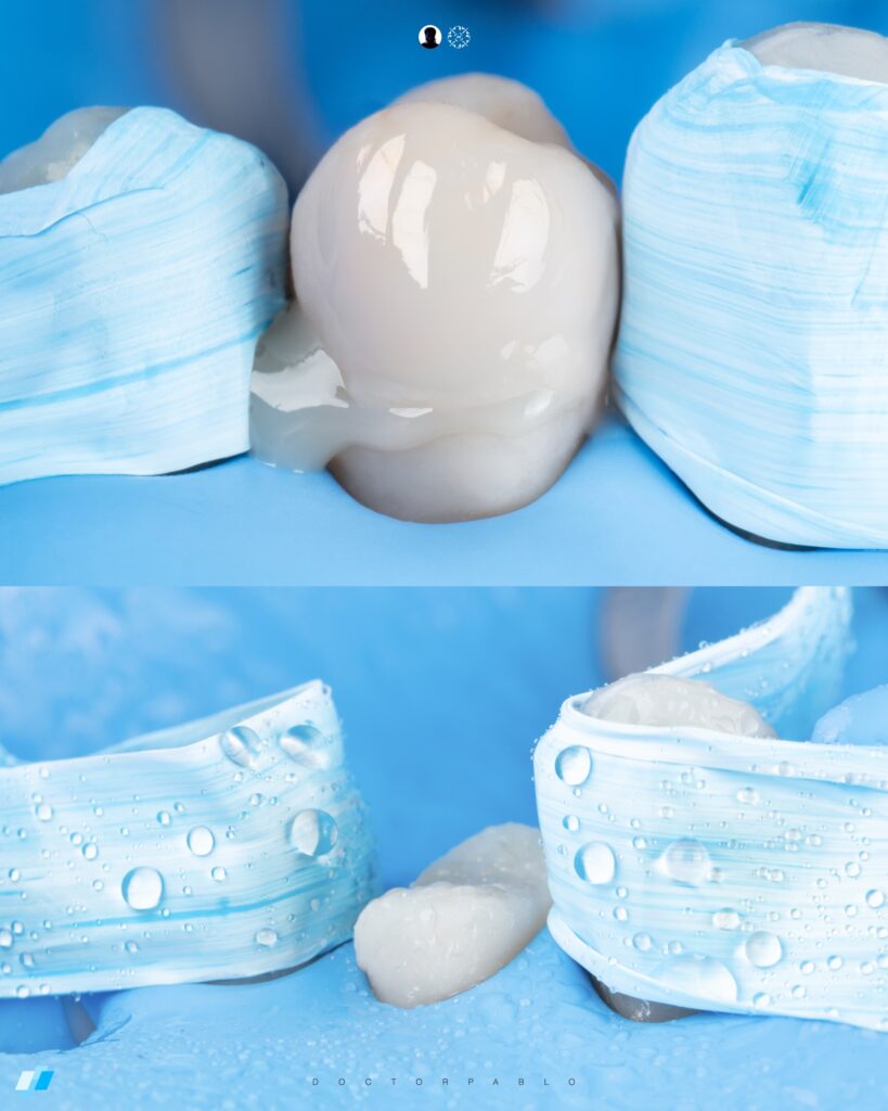 Indirect Restoration Cementation