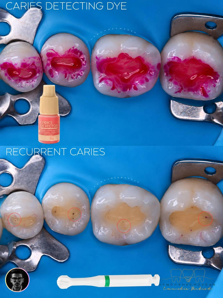 Dye Application & Caries Removal