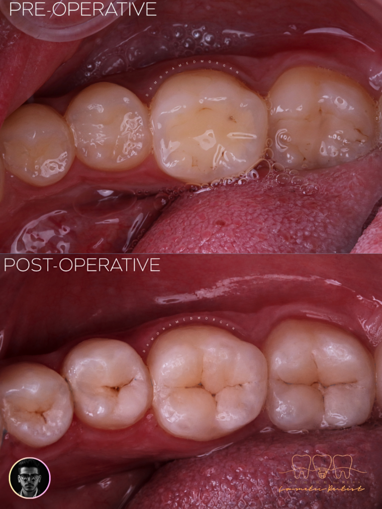 Before & After