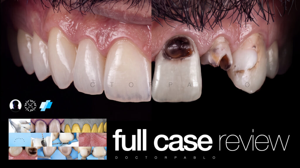 Anteior case MYZERO.001