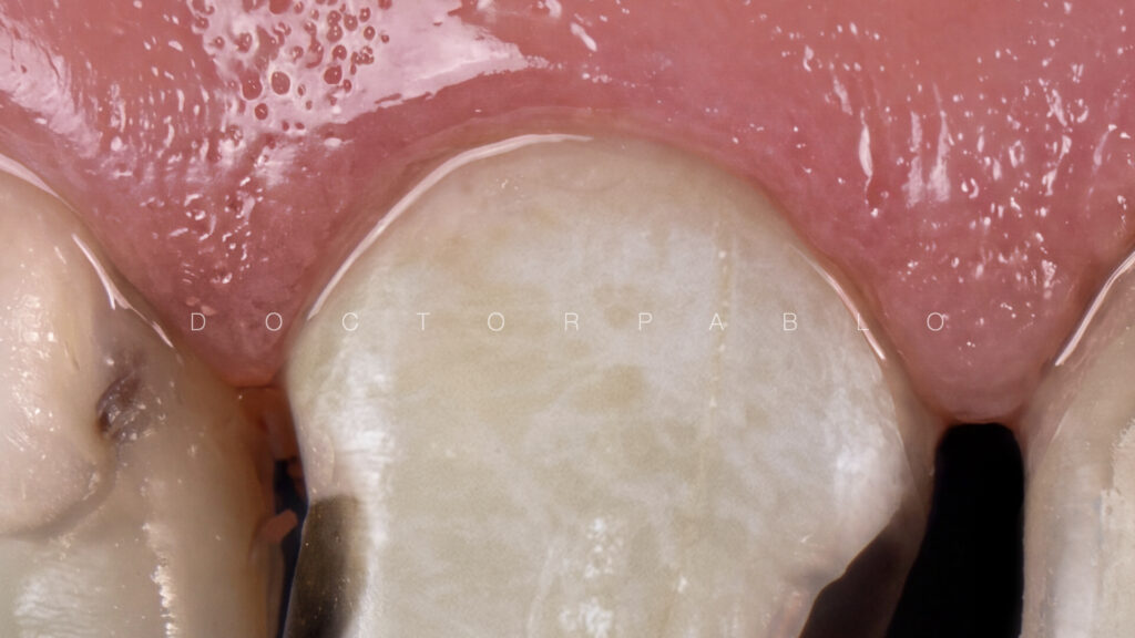 Anteior case MYZERO.002