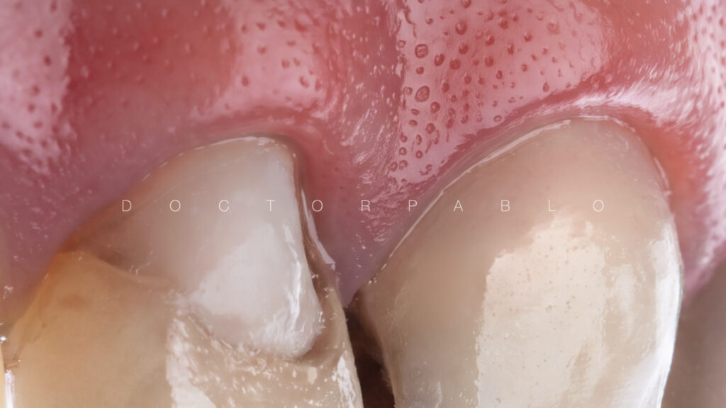 Anteior case MYZERO.003