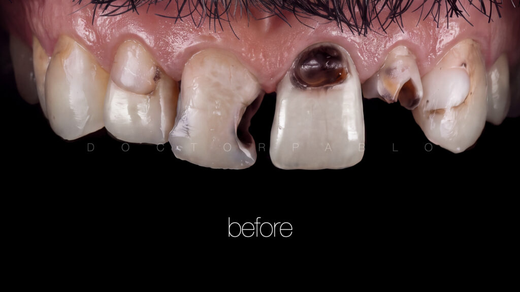 Anteior case MYZERO.005
