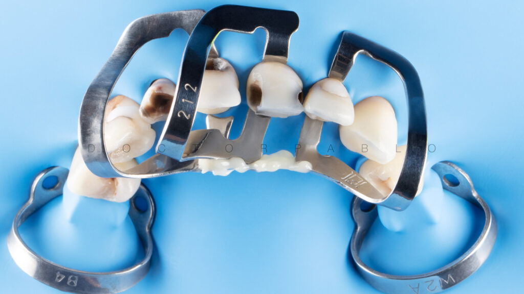 Anteior case MYZERO.007