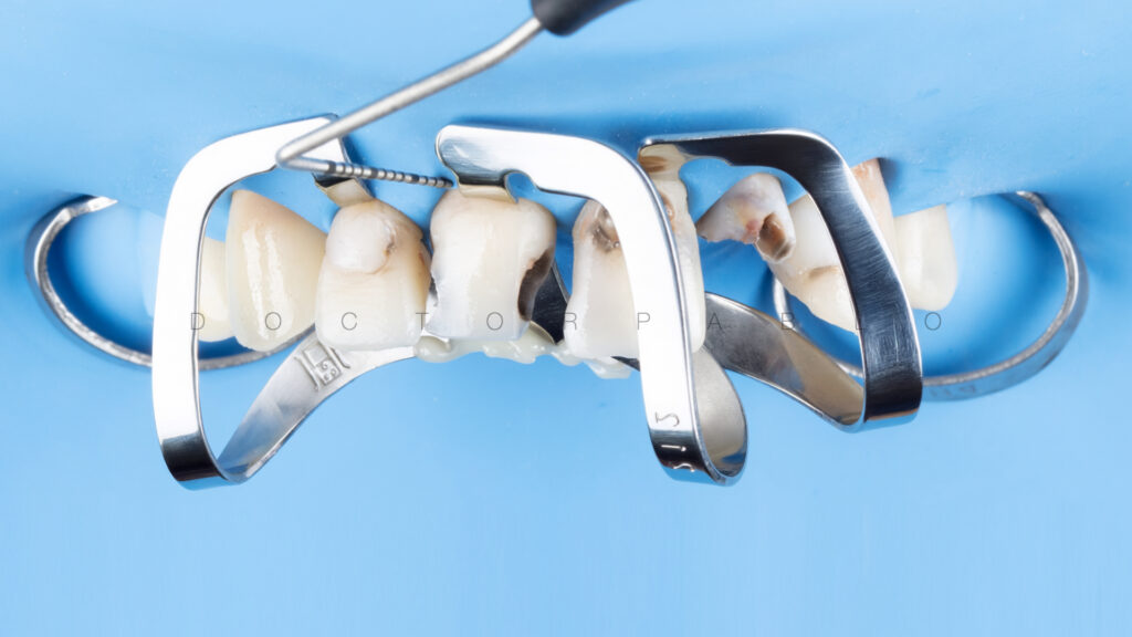 Anteior case MYZERO.009