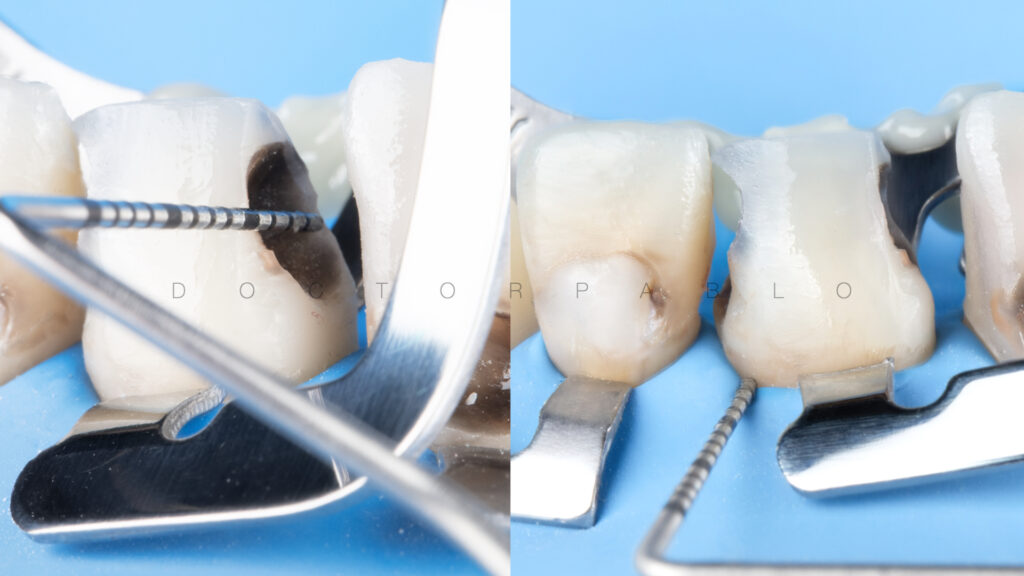 Anteior case MYZERO.010
