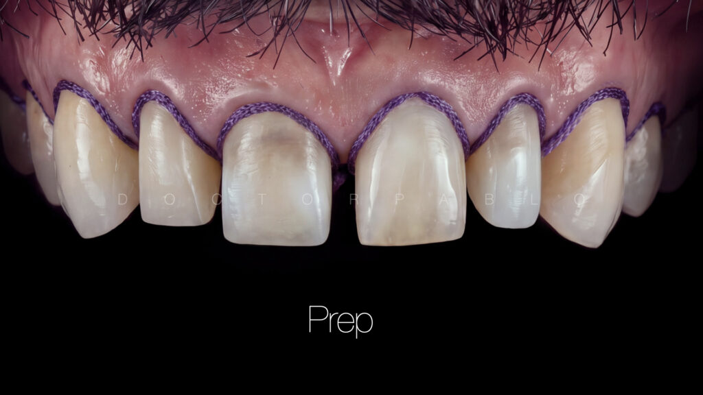 Anteior case MYZERO.011