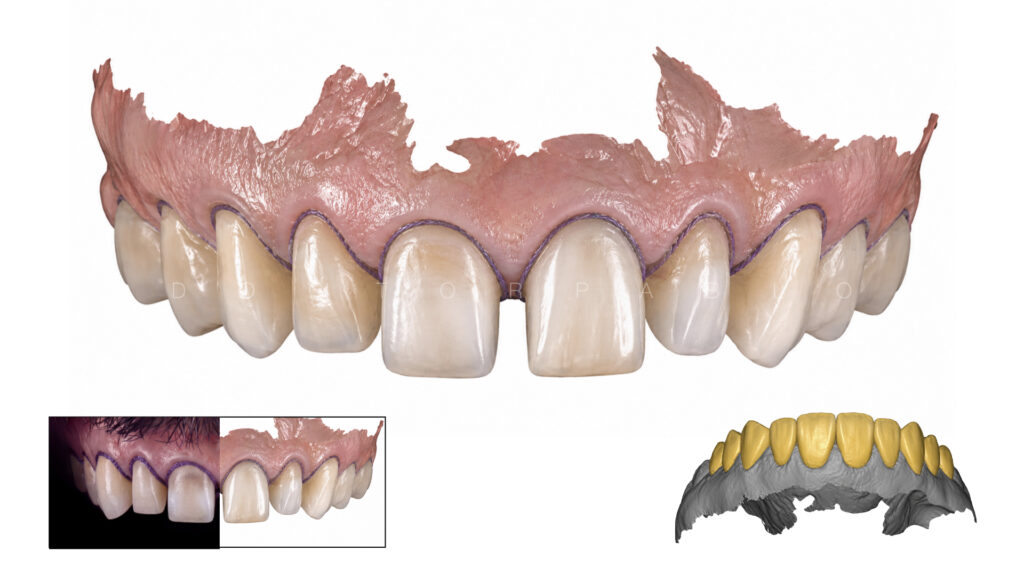 Anteior case MYZERO.012